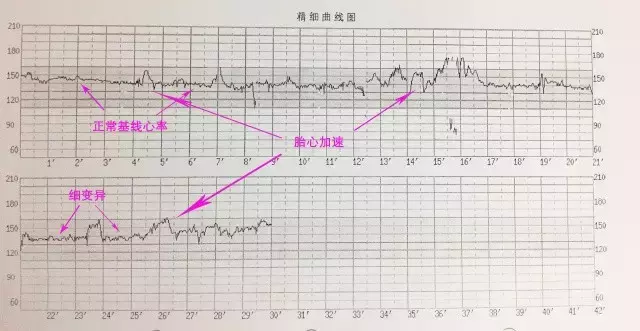胎心监护图怎么看(教你看懂胎心曲线)