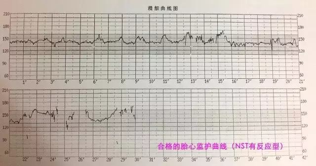 胎心监护图怎么看(教你看懂胎心曲线)