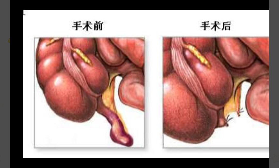 肚脐下方疼痛怎么回事(有可能是这种疾病)