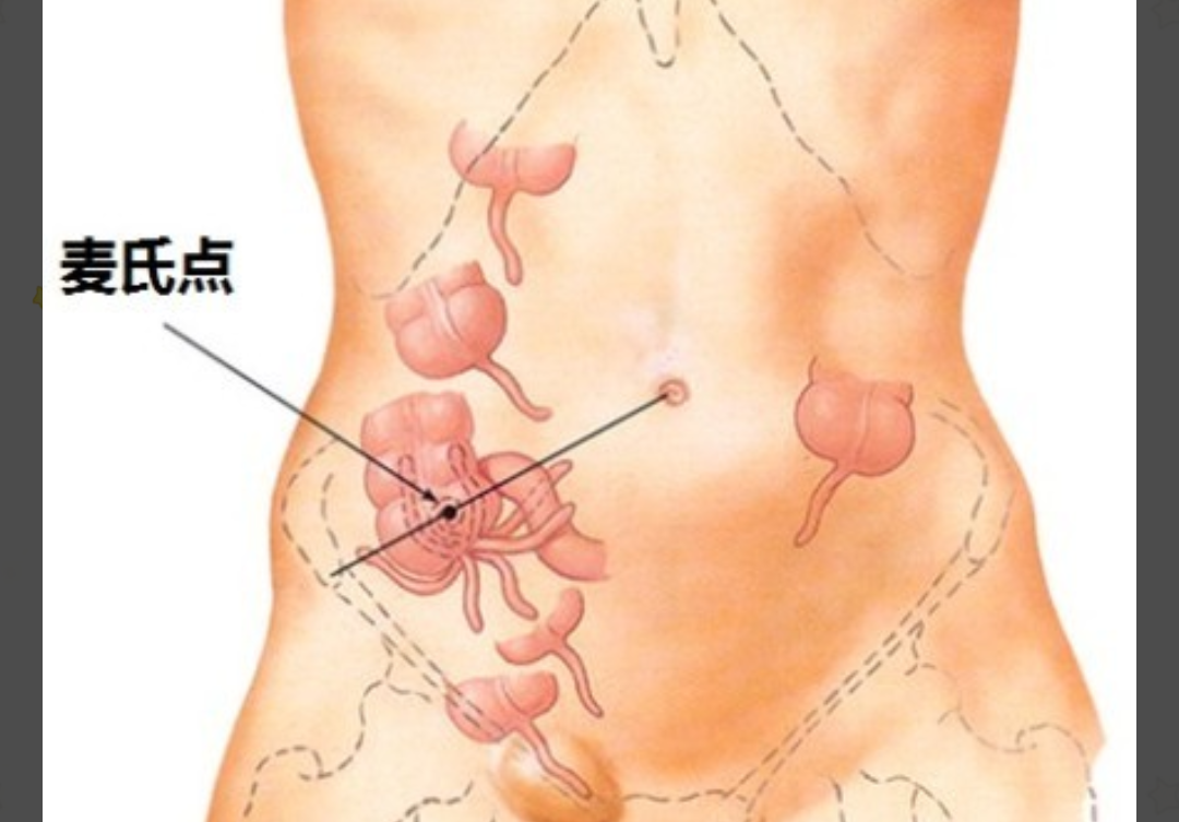 肚脐下方疼痛怎么回事(有可能是这种疾病)